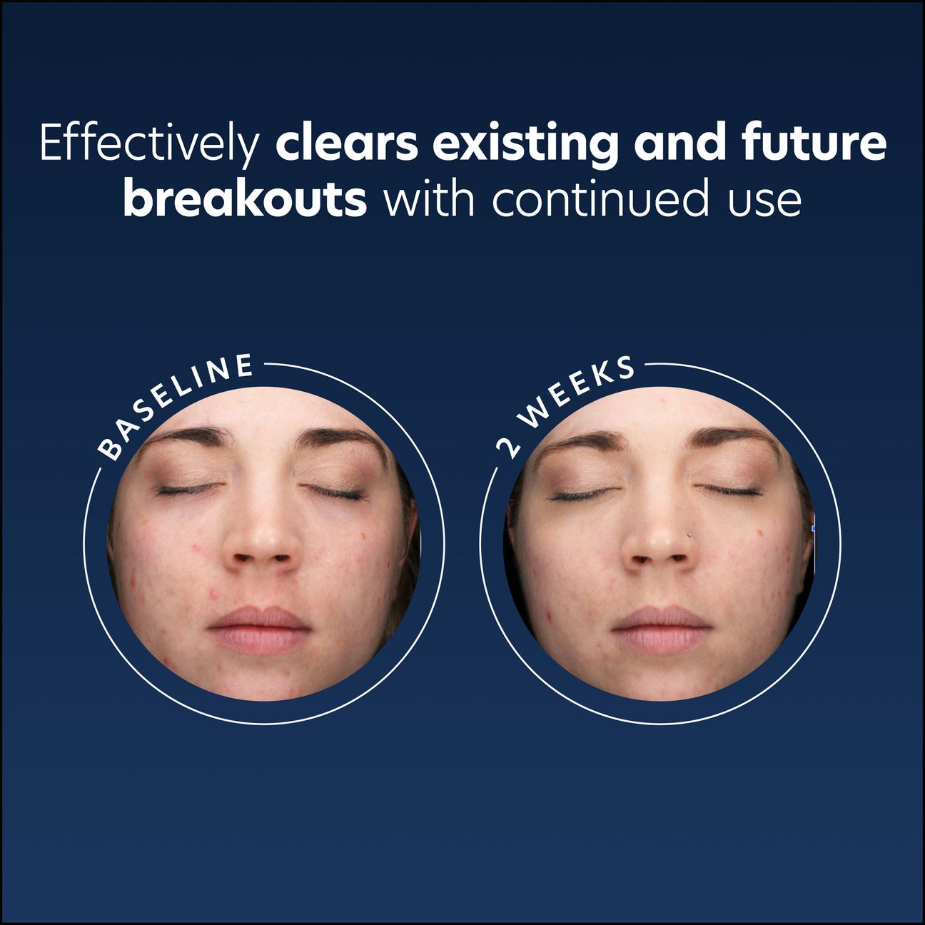 Acne Gel with OmniSome®